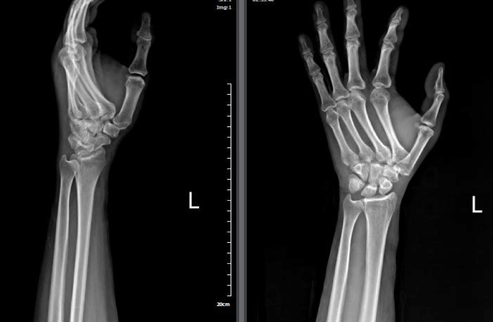 Multiple Carpometacarpal Joint Dislocation; a clinical image
