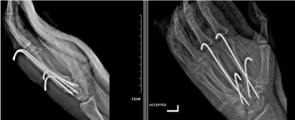 Multiple Carpometacarpal Joint Dislocation; a clinical image